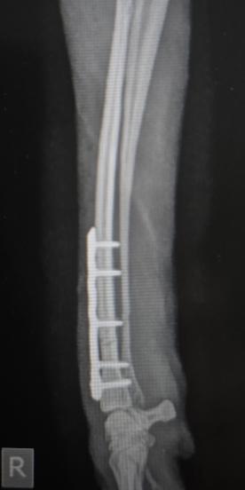 Röntgenaufnahme der stabilisierten Unterarmfraktur mit Implantaten (Osteosynthese).
