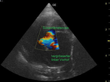 dynamische subaorta- und midventrikuläre Obstruktionen führen zum links-Herzversagen