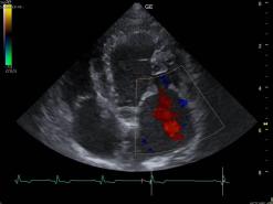 deutlich vergrösserter linker Vorhof und Ventrikel