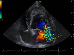 Ausmass des Pendelblutes in den linken Vorhof in Farben.