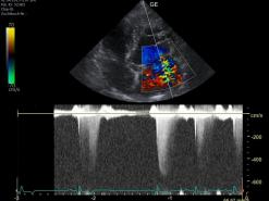 Druckmessungen zwischen dem linken Vorhof und Ventrikel.