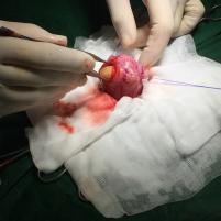 Blasenstein-OP