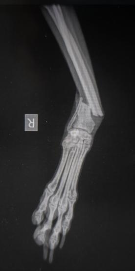 Geschlossene Unterarmfraktur (Speiche und Elle sind gleichermassen gebrochen).