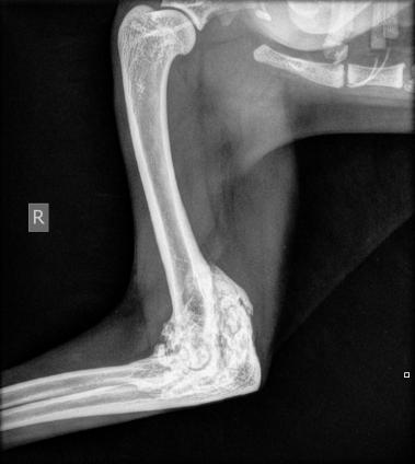 Hochgradige Arthrose des rechten Ellbogens