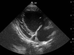 Vergrösserter Vorhof-Ventrikel und verdickte Klappen.