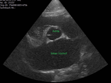 durch Rückfluss hochgradig vergrösserter Vorhof: Aorta/linkem Vorhof > 1.5