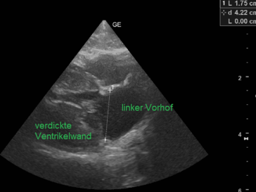 verdickte Ventrikelwand mit vergrössertem linkem Vorhof