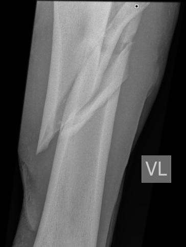 Fraktur eines langen Röhrenknochens