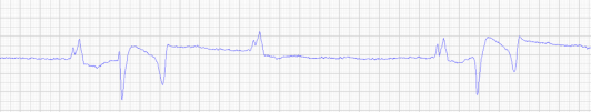 Ausschnitt eines EKG