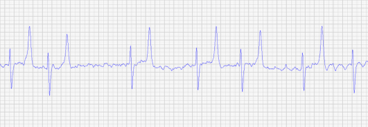 EKG Veränderungen beim Vorhofflimmern