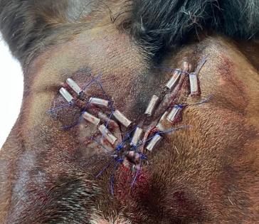 Weiteres Beispiel einer primär verschlossenen Wunde am Kopf. Hier wurden zerschnittene Infusionsschläuche als Hautschutz verwendet, um Entlastungsnähte anzulegen, die die Spannung auf die Wundränder reduzieren.