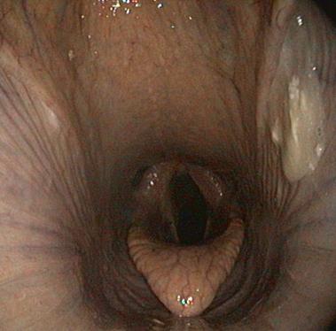 Eiter aus linkem Luftsack