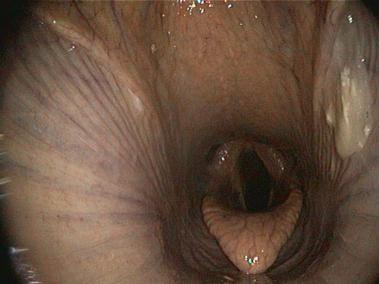 Druse - Eiter aus Luftsack