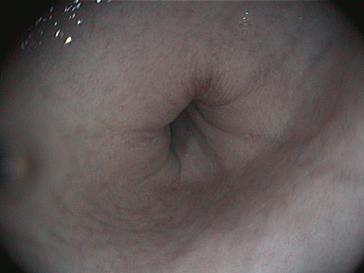 Mageneingang (Cardia)