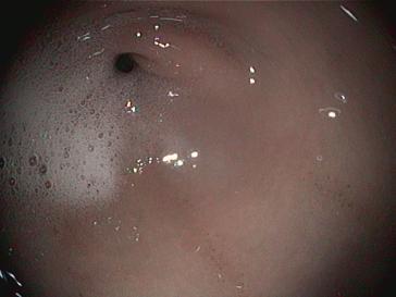 Pylorus (Magenausgang)