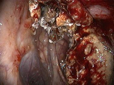 Endoskopieaufnahme des befallenen Luftsacks. Die Pilzauflagerungen sind deutlich sichtbar.