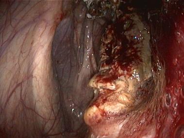 Endoskopieaufnahme des befallenen Luftsacks. Die Pilzauflagerungen sind deutlich sichtbar.