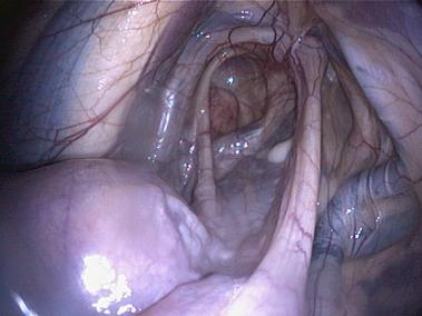 vergrösserter Lymphknoten in den Luftsack vorwölbend